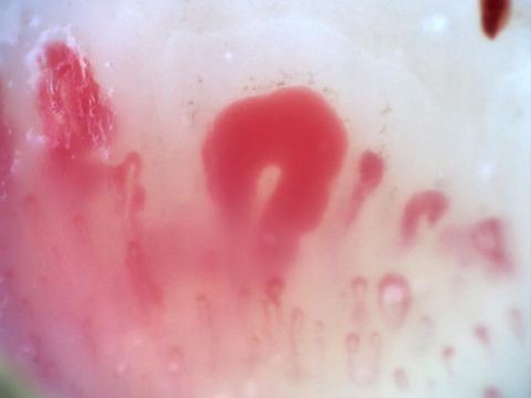 200x capillaroscopy field in systemic sclerosis showing very dilated megacapillaries