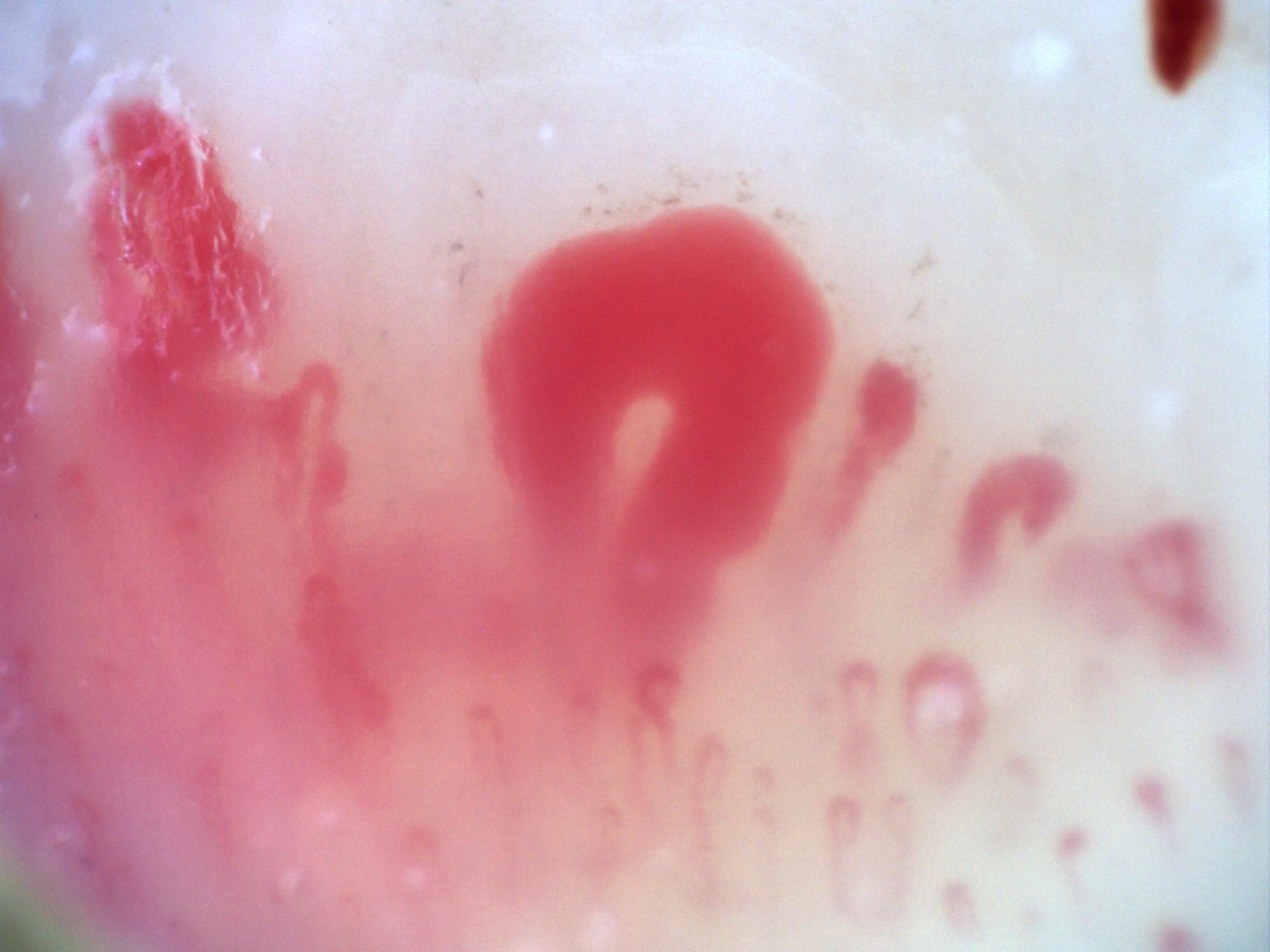 Campo de capilaroscopia 200x en esclerosis sistémica con megacapilares muy dilatados