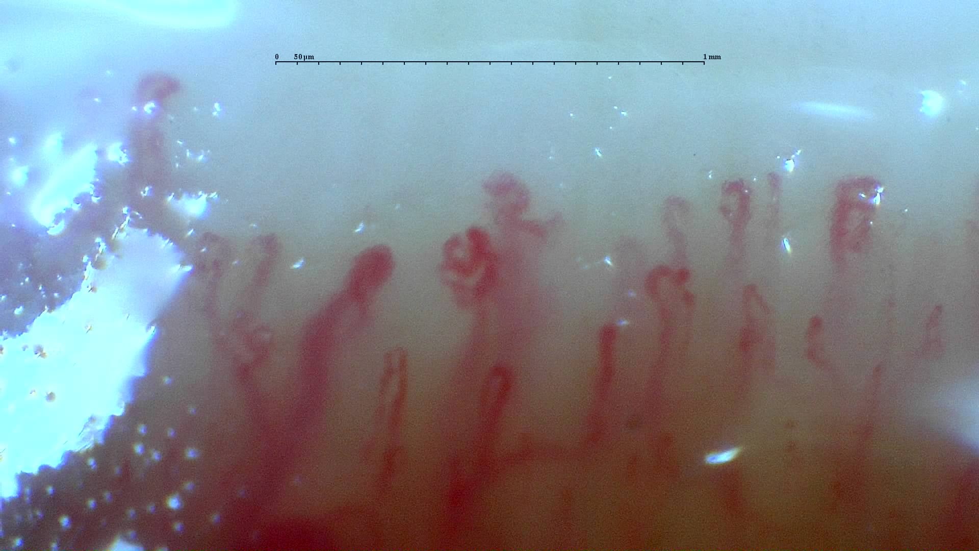 Imagen de vista previa de Enfermedad mixta del tejido conectivo con patrón similar al de la esclerosis sistémica no clasificable