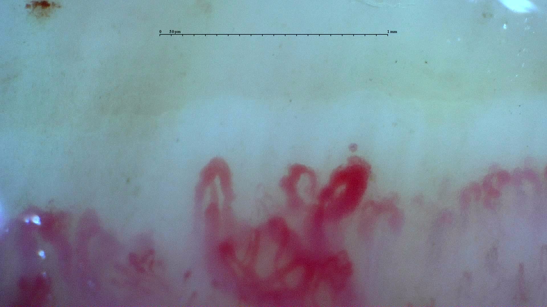 Preview image for Systemic Sclerosis with anti-U3 RNP: Late Microangiopathy