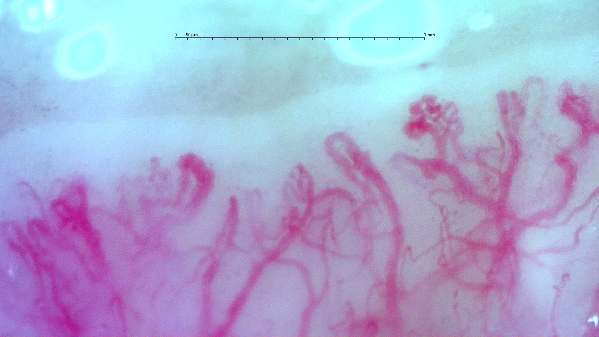 Preview image for Anti-TIF1γ Dermatomyositis with Scleroderma-Like Pattern