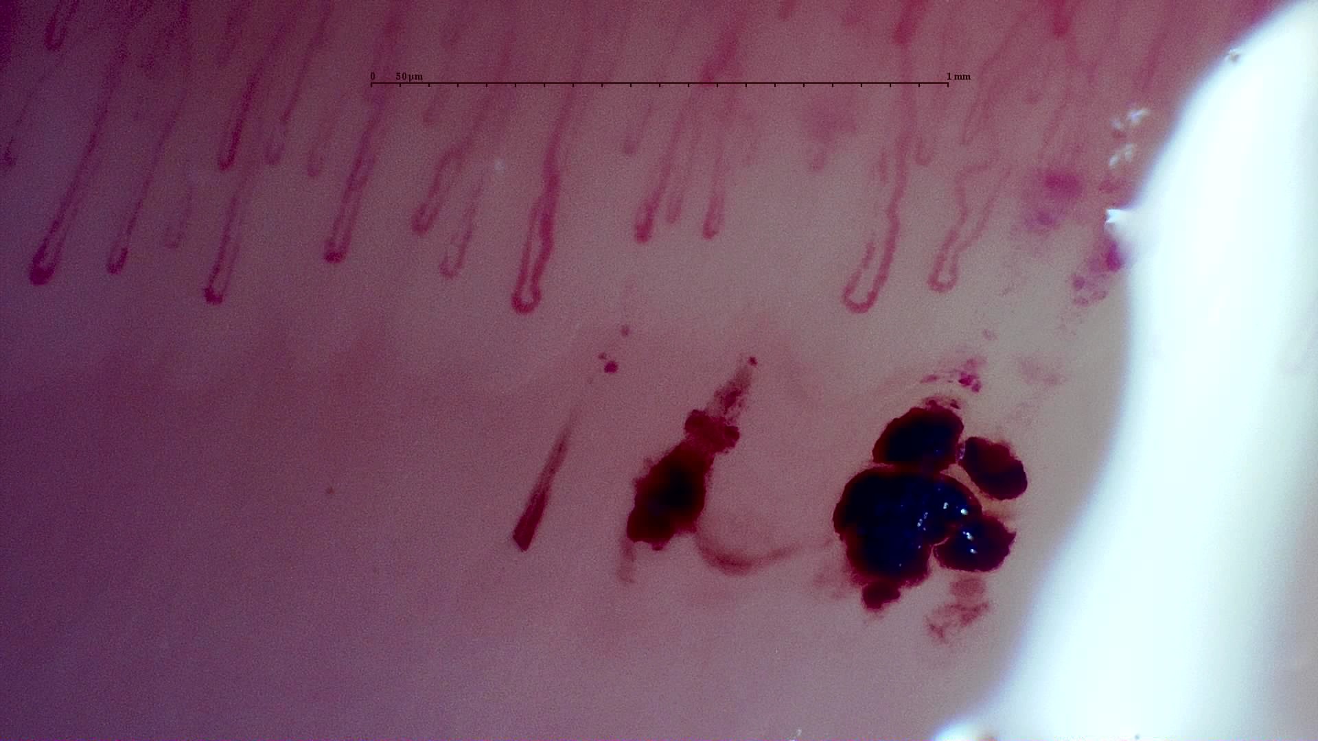 Imagen de vista previa de Vasculitis MPO-ANCA con glomerulonefritis rápidamente progresiva
