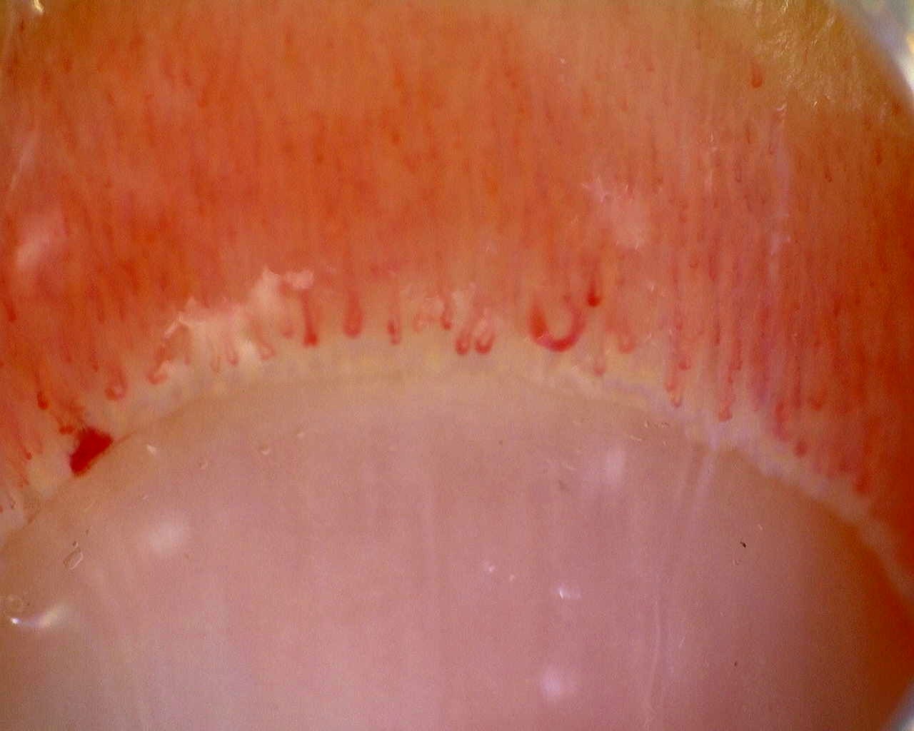 Imagen de vista previa de Esclerosis sistémica cutánea limitada (ACA+) con patrón activo de Cutolo