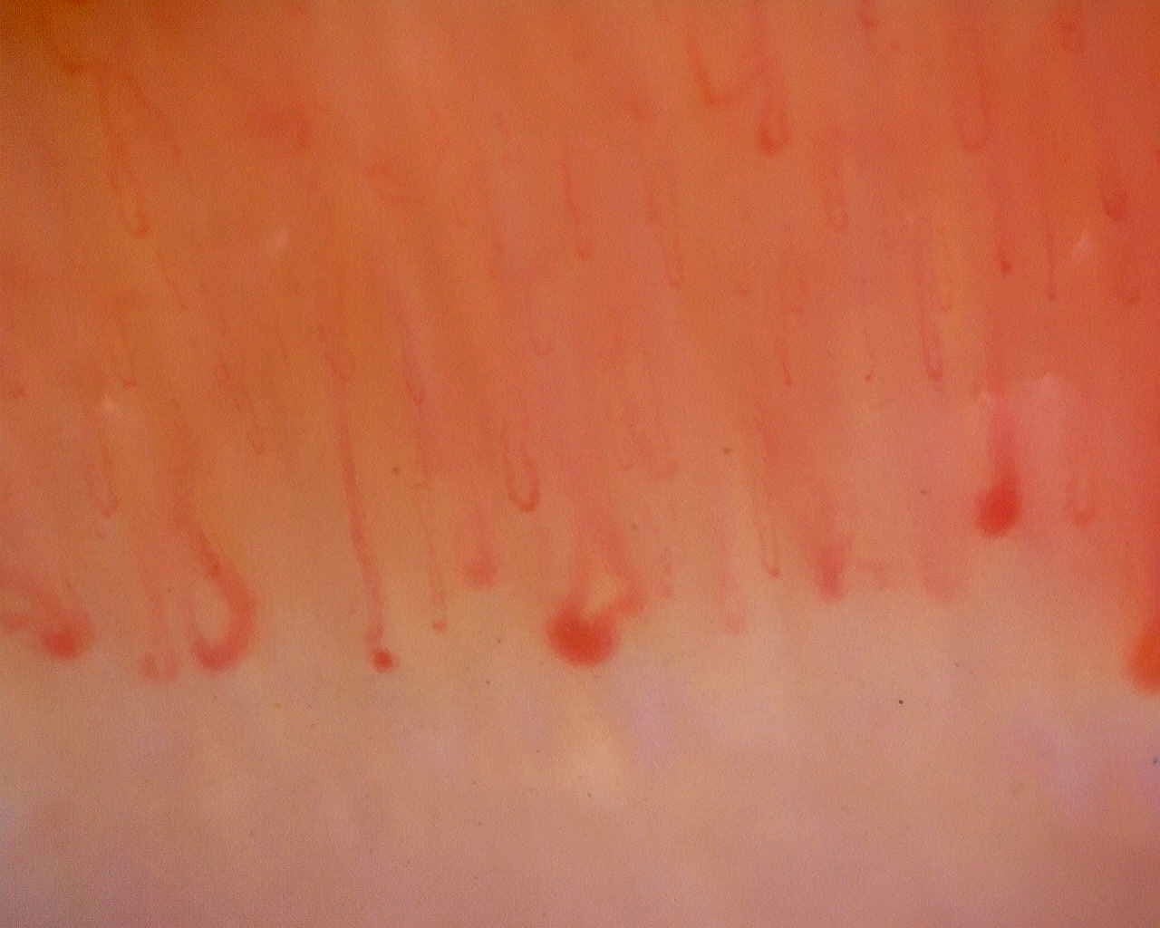 Nailfold capillaroscopy: right little finger, field c. Limited Cutaneous Systemic Sclerosis (ACA+) with Active Cutolo Pattern.