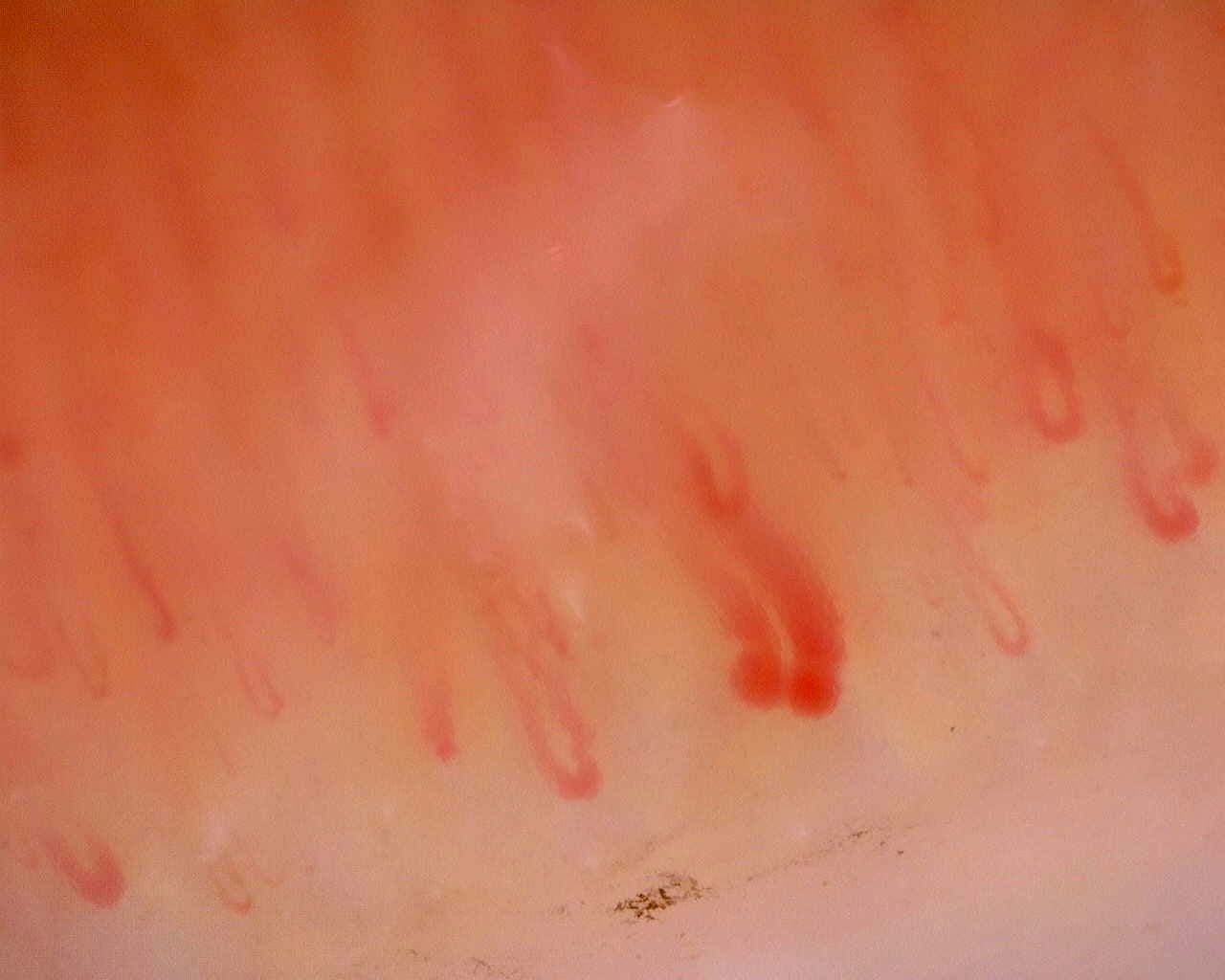 Nailfold capillaroscopy: right index finger, field d. Limited Cutaneous Systemic Sclerosis (ACA+) with Active Cutolo Pattern.
