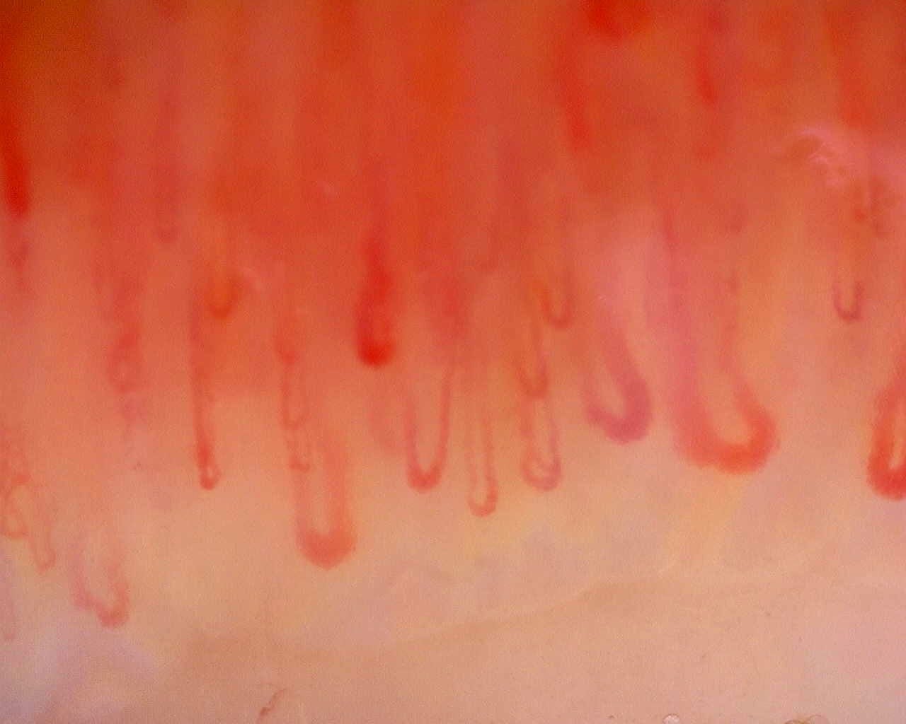 Nailfold capillaroscopy: left index finger, field b. Limited Cutaneous Systemic Sclerosis (ACA+) with Active Cutolo Pattern.