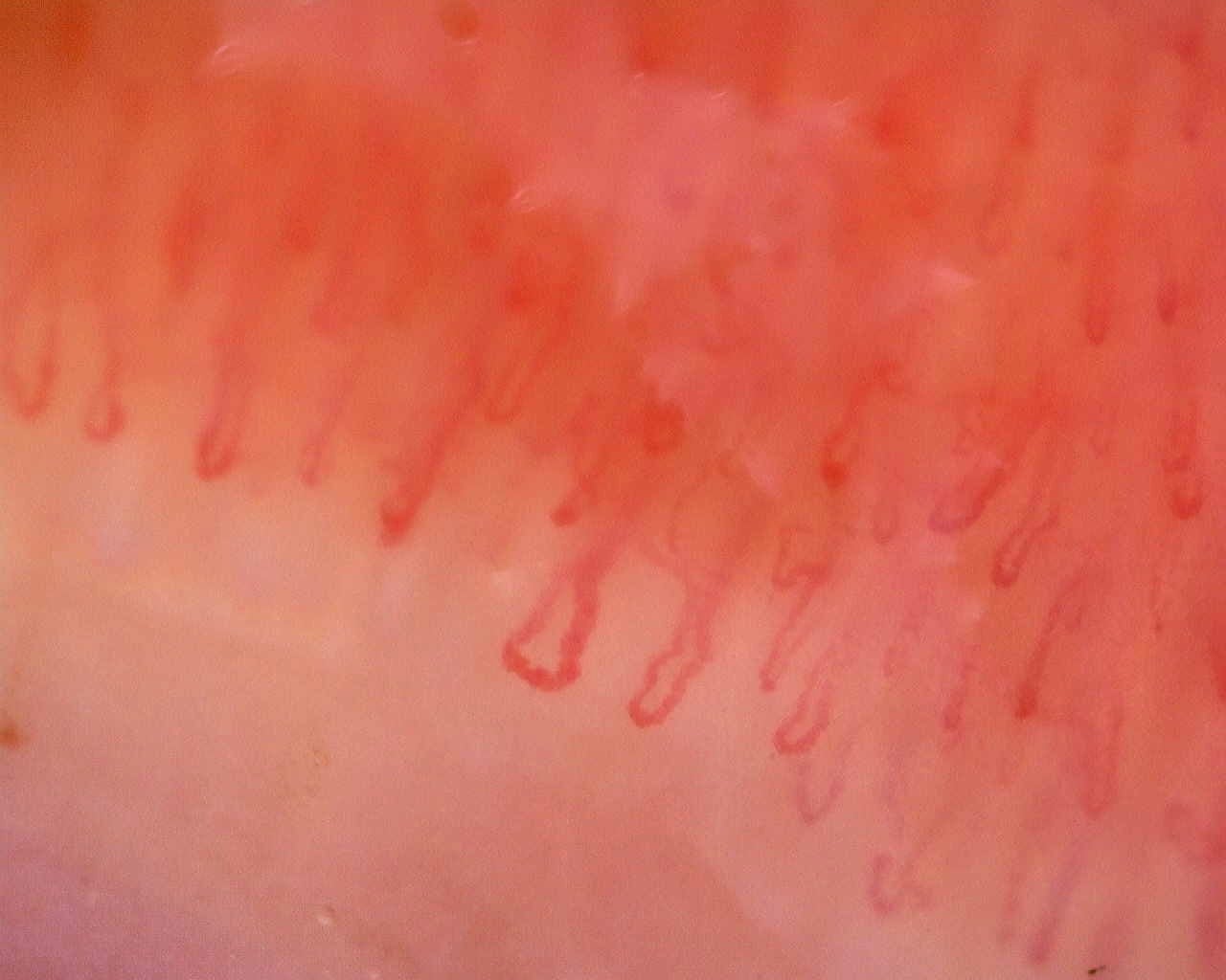 Nailfold capillaroscopy: left little finger, field d. Limited Cutaneous Systemic Sclerosis (ACA+) with Active Cutolo Pattern.