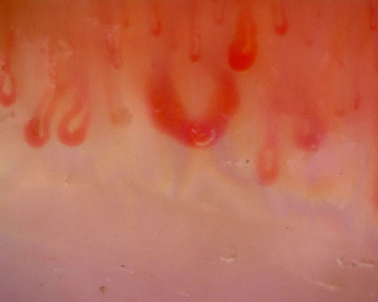 Nailfold capillaroscopy: right ring finger, field b. Limited Cutaneous Systemic Sclerosis (ACA+) with Active Cutolo Pattern.