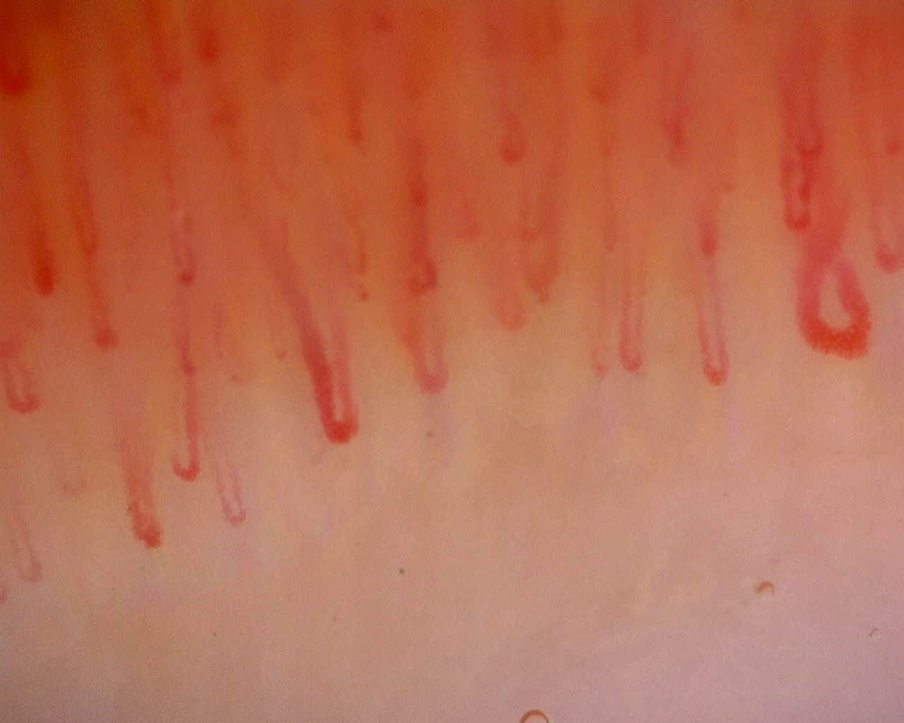 Nailfold capillaroscopy: left middle finger, field b. Limited Cutaneous Systemic Sclerosis (ACA+) with Active Cutolo Pattern.