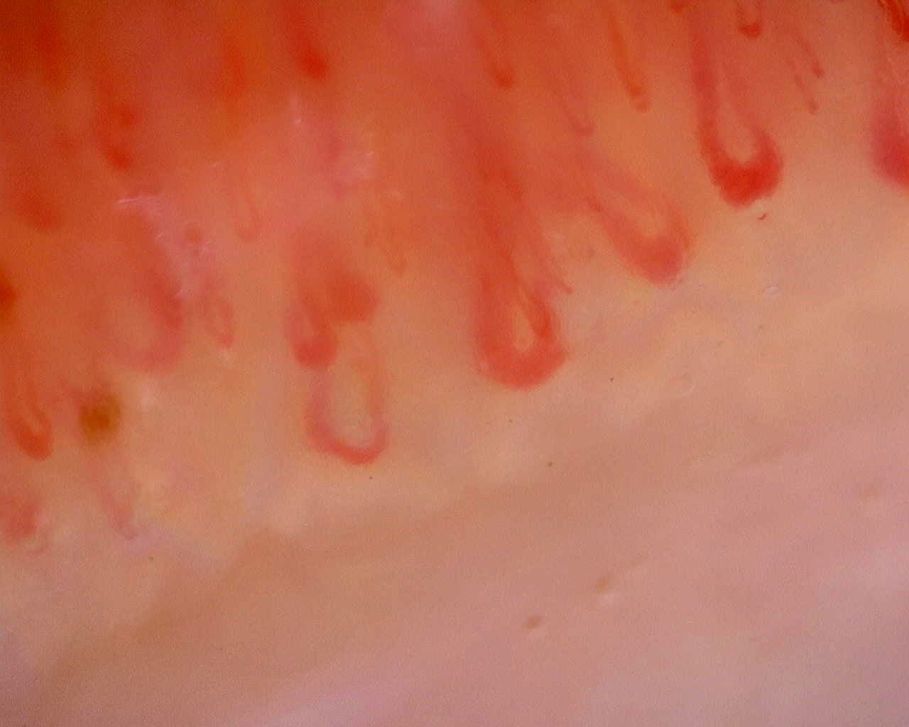 Nailfold capillaroscopy: right middle finger, field d. Limited Cutaneous Systemic Sclerosis (ACA+) with Active Cutolo Pattern.