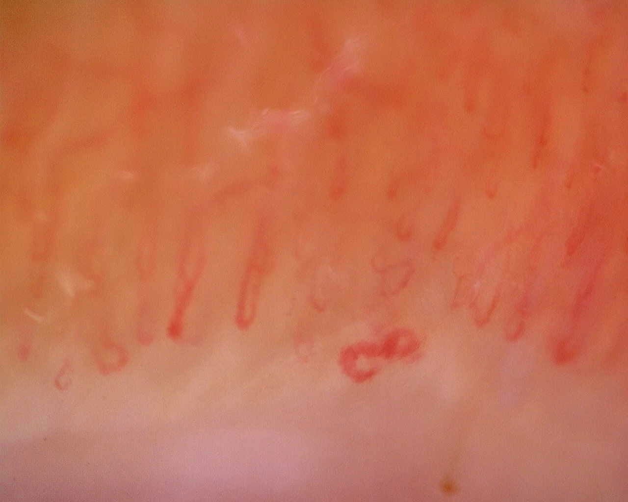 Nailfold capillaroscopy: left little finger, field c. Limited Cutaneous Systemic Sclerosis (ACA+) with Active Cutolo Pattern.