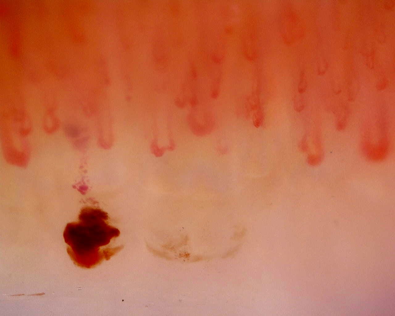 Nailfold capillaroscopy: right index finger, field b. Limited Cutaneous Systemic Sclerosis (ACA+) with Active Cutolo Pattern.