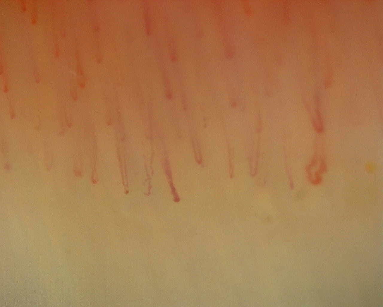 Capilaroscopia periungueal: anular derecho, campo b. Patrón inespecífico: caso representativo.
