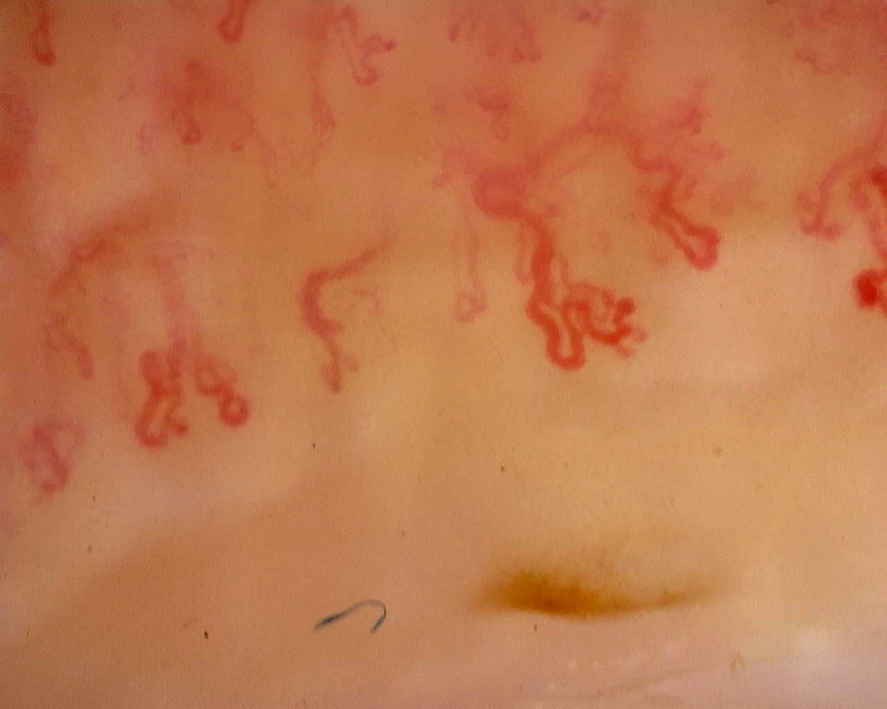 Imagen de vista previa de Cutolo tardío en SSc: caso representativo