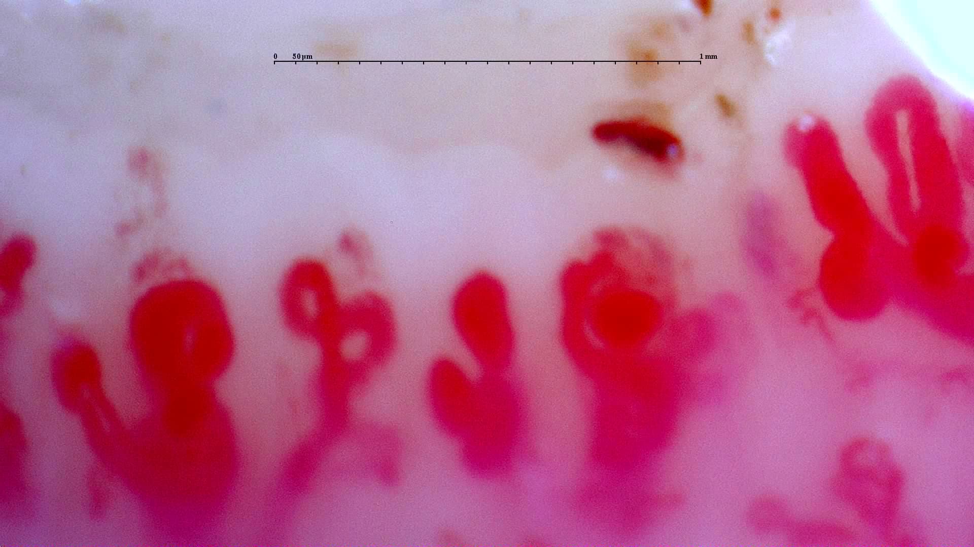 Patrón esclerodermiforme