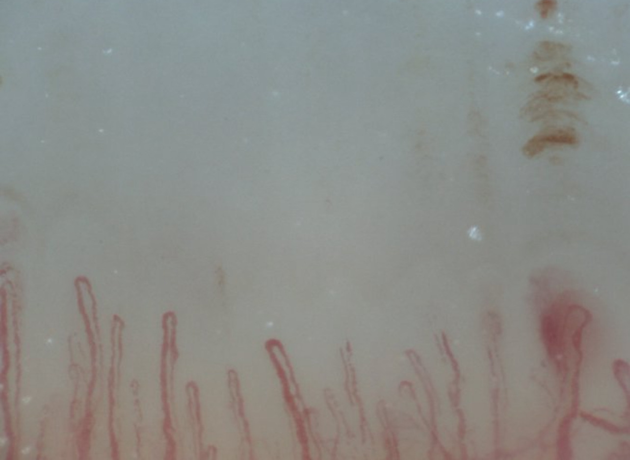 Slender hairpin capillaries with several elongated brown hemorrhagic deposits above the right side.