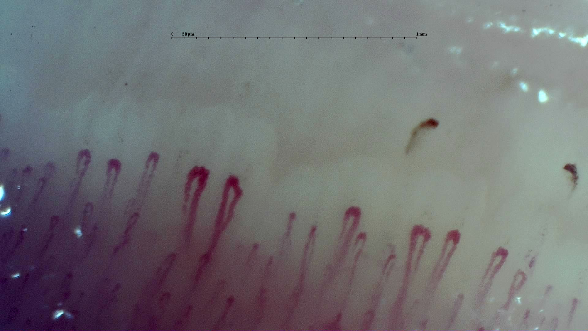 Broad hairpin capillaries beside shorter fine loops, with two small brown hemorrhagic deposits above the right half.